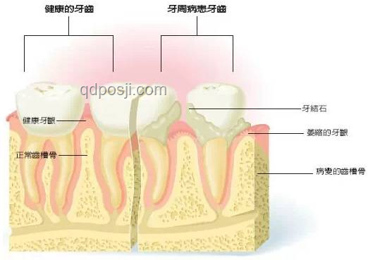 韦东奕牙周炎事件引发的公众健康意识洞察